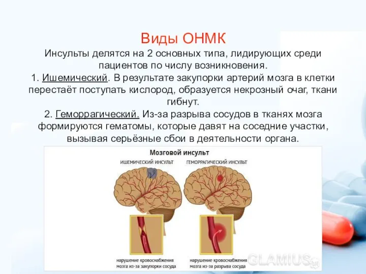 Виды ОНМК Инсульты делятся на 2 основных типа, лидирующих среди пациентов по