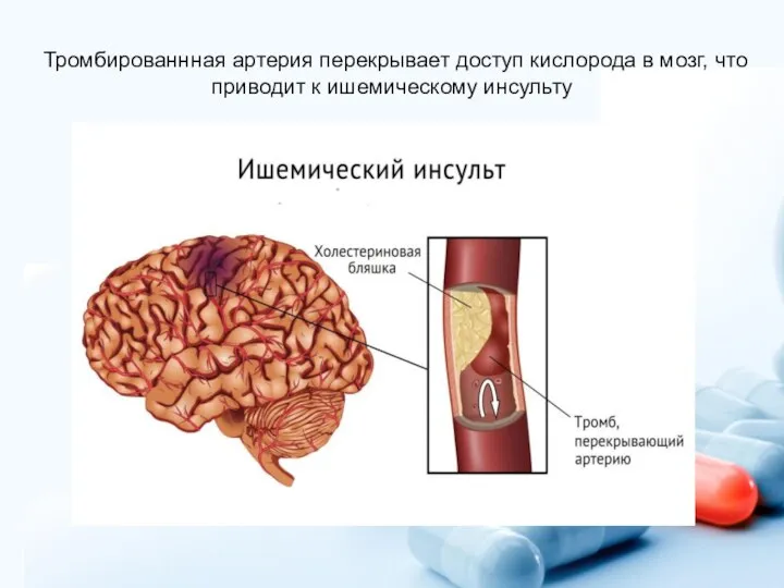 Тромбированнная артерия перекрывает доступ кислорода в мозг, что приводит к ишемическому инсульту