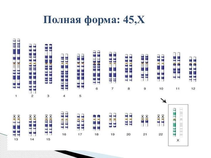 Полная форма: 45,Х