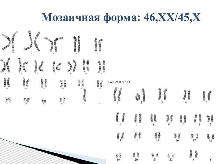 Мозаичная форма: 46,ХХ/45,Х