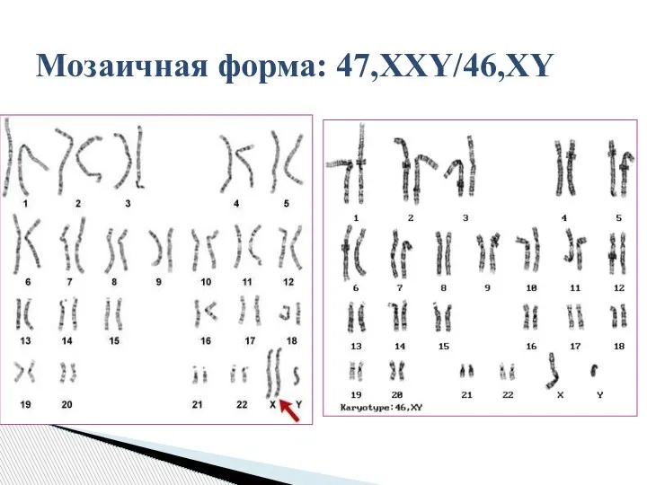 Мозаичная форма: 47,XXY/46,XY