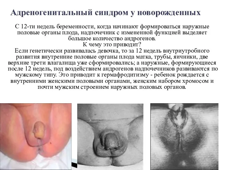 Адреногенитальный синдром у новорожденных С 12-ти недель беременности, когда начинают формироваться наружные