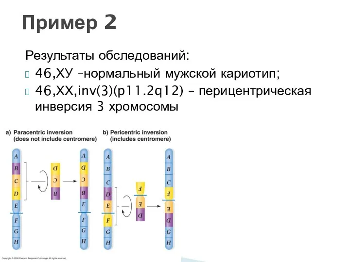 Результаты обследований: 46,ХУ –нормальный мужской кариотип; 46,ХХ,inv(3)(p11.2q12) – перицентрическая инверсия 3 хромосомы Пример 2