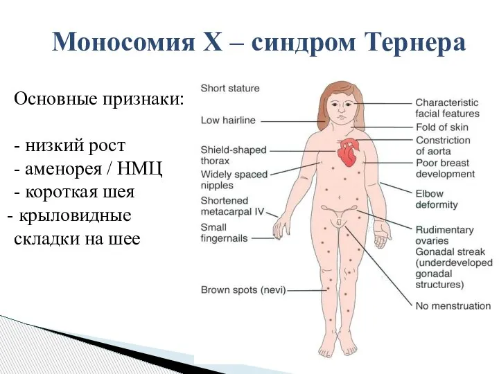 Основные признаки: - низкий рост - аменорея / НМЦ - короткая шея