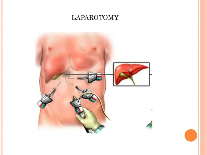 laparotomy