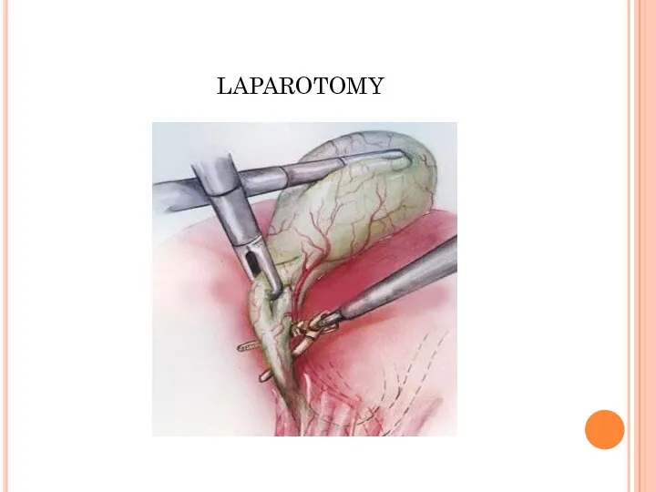 laparotomy