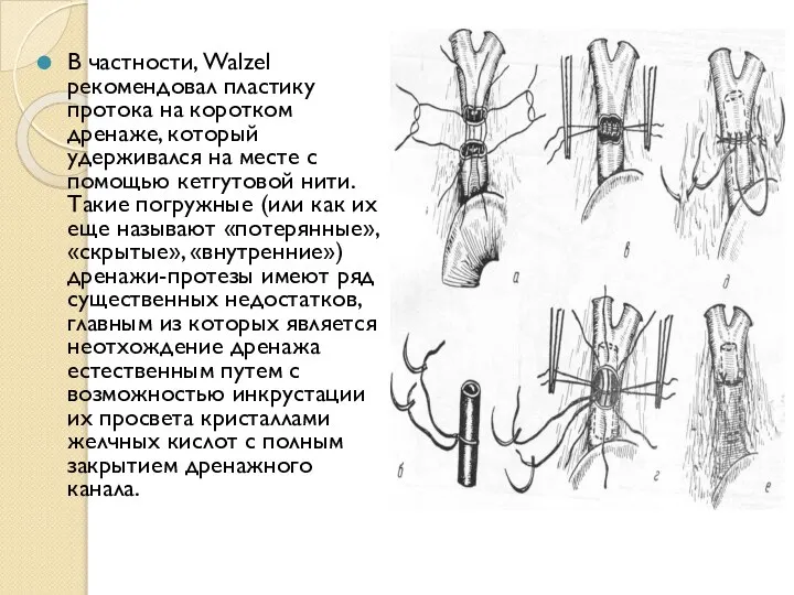 В частности, Walzel рекомендовал пластику протока на коротком дренаже, который удерживался на
