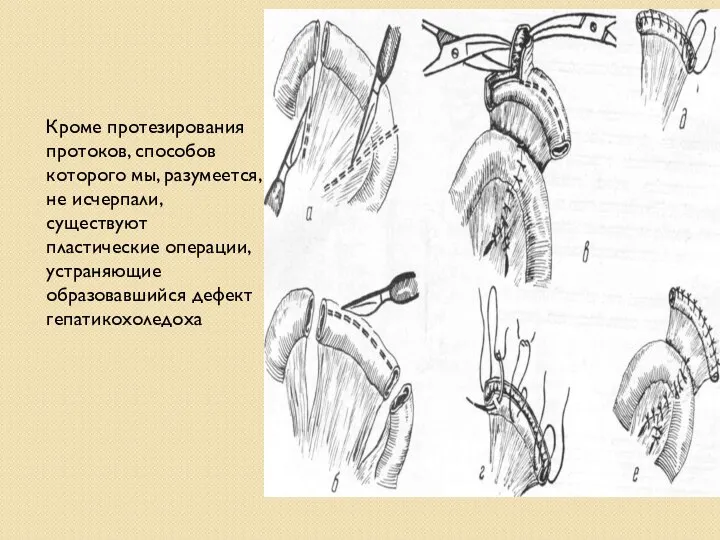 Кроме протезирования протоков, способов которого мы, разумеется, не исчерпали, существуют пластические операции, устраняющие образовавшийся дефект гепатикохоледоха