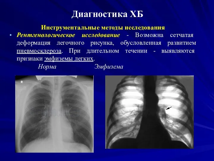 Диагностика ХБ Инструментальные методы исследования Рентгенологическое исследование - Возможна сетчатая деформация легочного