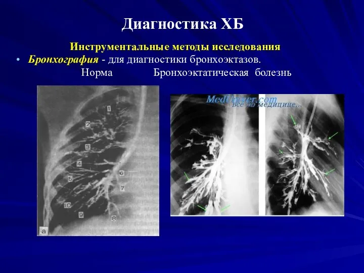 Диагностика ХБ Инструментальные методы исследования Бронхография - для диагностики бронхоэктазов. Норма Бронхоэктатическая болезнь