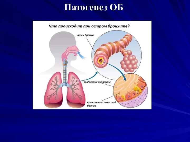 Патогенез ОБ