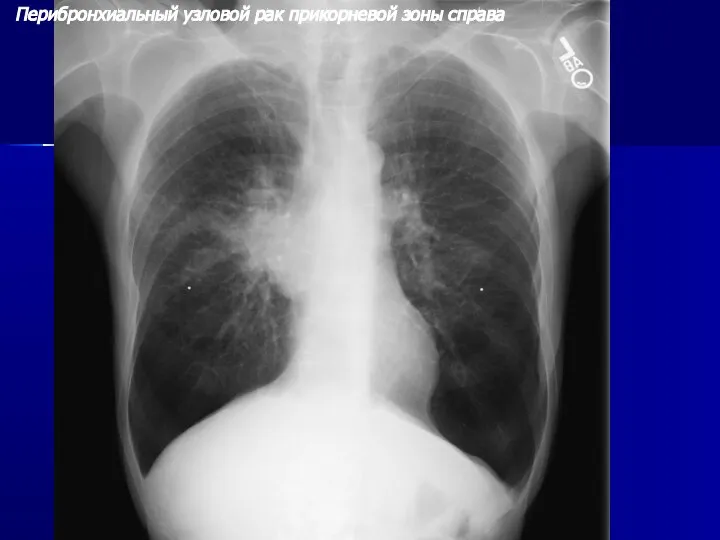 Перибронхиальный узловой рак прикорневой зоны справа
