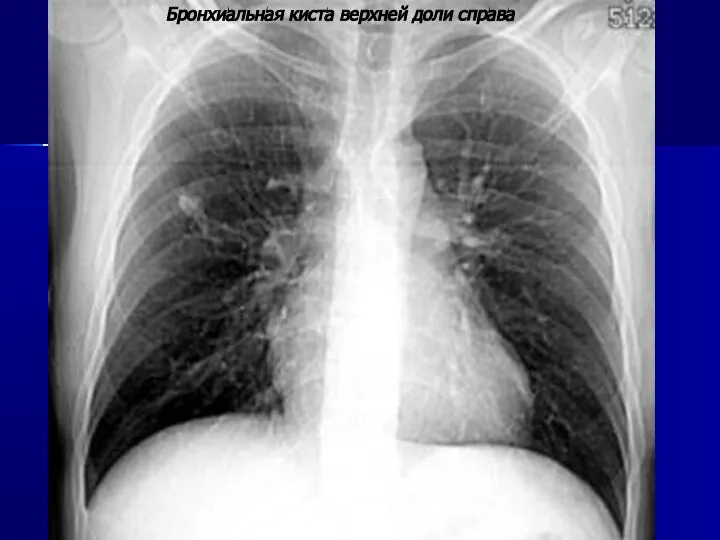 Бронхиальная киста верхней доли справа Бронхиальная киста верхней доли справа