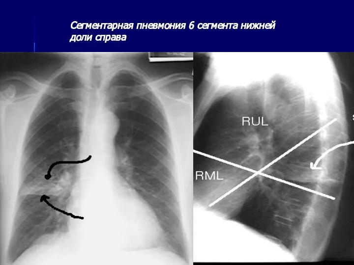 Сегментарная пневмония 6 сегмента нижней доли справа