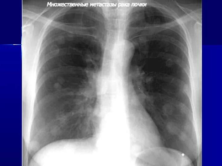 Множественные метастазы рака почки