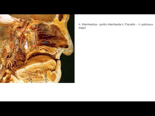 n. Intermedius - portio intermedia n. Facialis - n. petrosus major