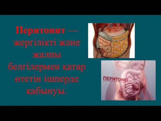 Перитонит — жергілікті және жалпы белгілермен қатар өтетін ішперде қабынуы.