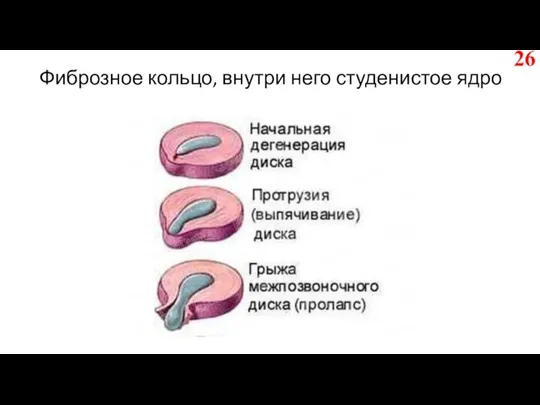 Фиброзное кольцо, внутри него студенистое ядро