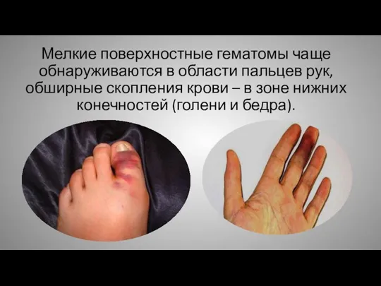 Мелкие поверхностные гематомы чаще обнаруживаются в области пальцев рук, обширные скопления крови