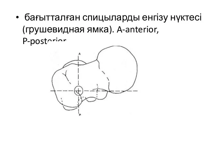 бағытталған спицыларды енгізу нүктесі (грушевидная ямка). A-anterior, P-posterior.