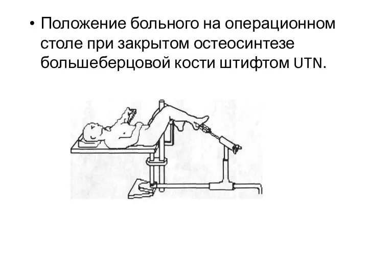 Положение больного на операционном столе при закрытом остеосинтезе большеберцовой кости штифтом UTN.