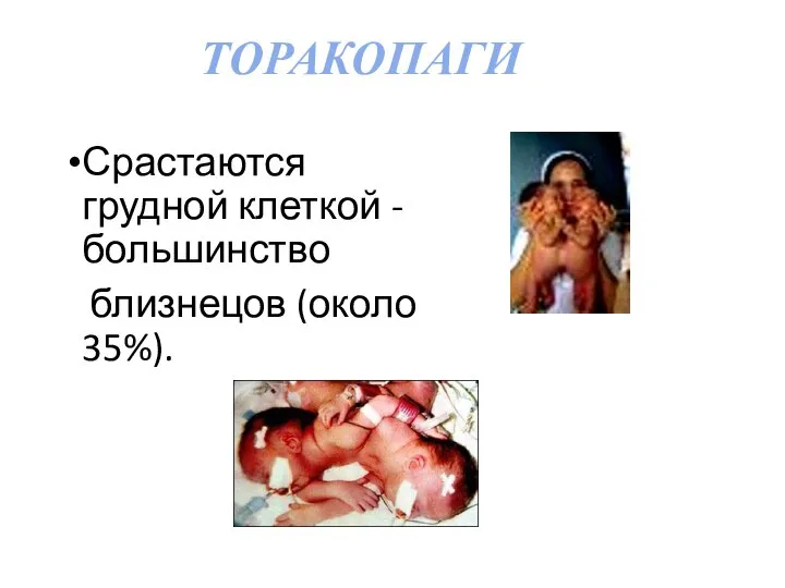 ТОРАКОПАГИ Срастаются грудной клеткой -большинство близнецов (около 35%).