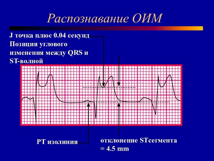 Распознавание ОИМ PT изолиния отклонение STсегмента = 4.5 mm J точка плюс