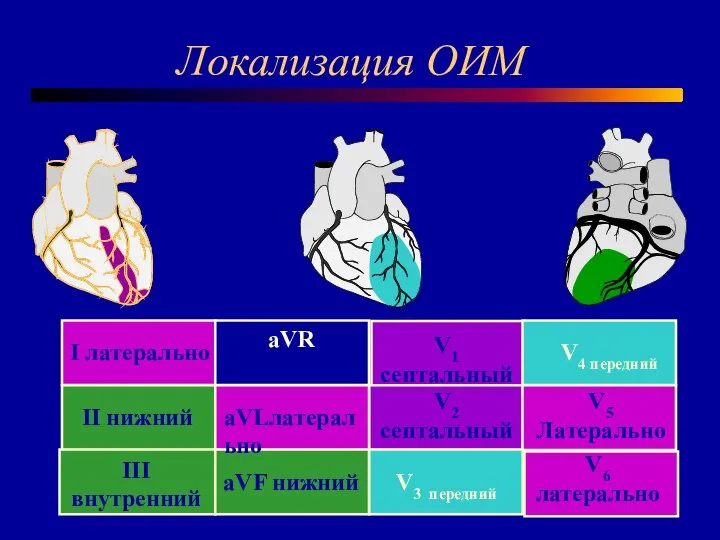 Локализация ОИМ aVF нижний III внутренний V3 передний V6 латерально aVLлатерально II