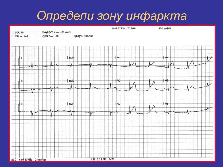 Определи зону инфаркта