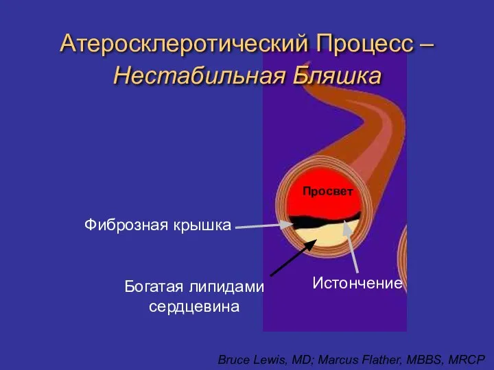 Атеросклеротический Процесс – Нестабильная Бляшка Просвет Истончение Богатая липидами сердцевина Фиброзная крышка