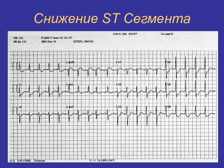 Снижение ST Сегмента