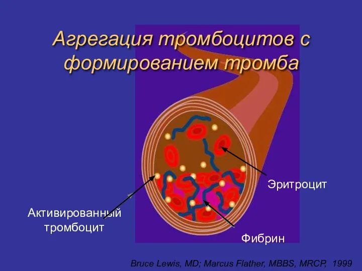 Агрегация тромбоцитов с формированием тромба Активированный тромбоцит Фибрин Эритроцит Bruce Lewis, MD;