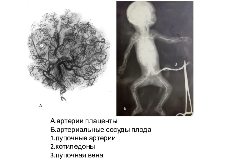 Б 3 А.артерии плаценты Б.артериальные сосуды плода 1.пупочные артерии 2.котиледоны 3.пупочная вена