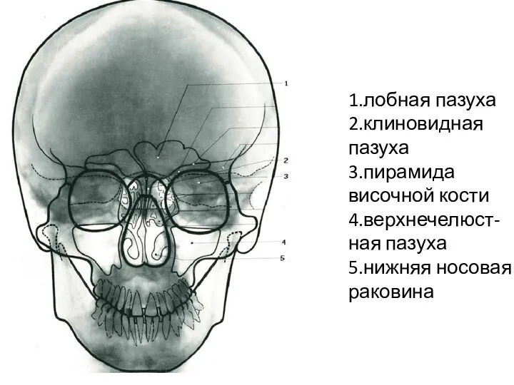 1.лобная пазуха 2.клиновидная пазуха 3.пирамида височной кости 4.верхнечелюст-ная пазуха 5.нижняя носовая раковина