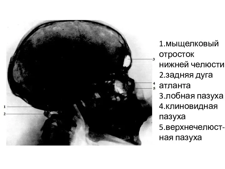 1.мыщелковый отросток нижней челюсти 2.задняя дуга атланта 3.лобная пазуха 4.клиновидная пазуха 5.верхнечелюст-ная пазуха