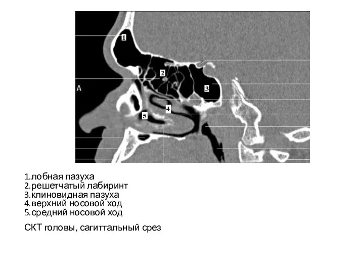 1.лобная пазуха 2.решетчатый лабиринт 3.клиновидная пазуха 4.верхний носовой ход 5.средний носовой ход СКТ головы, сагиттальный срез