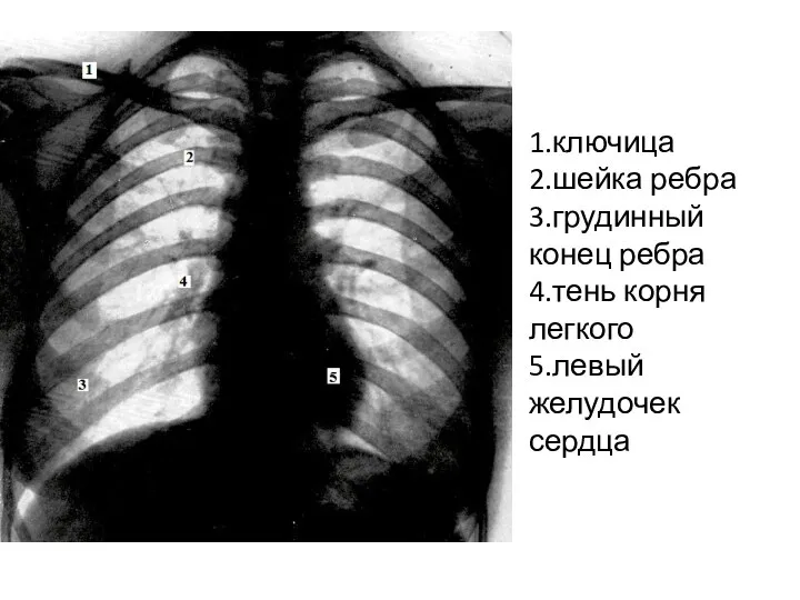 1.ключица 2.шейка ребра 3.грудинный конец ребра 4.тень корня легкого 5.левый желудочек сердца