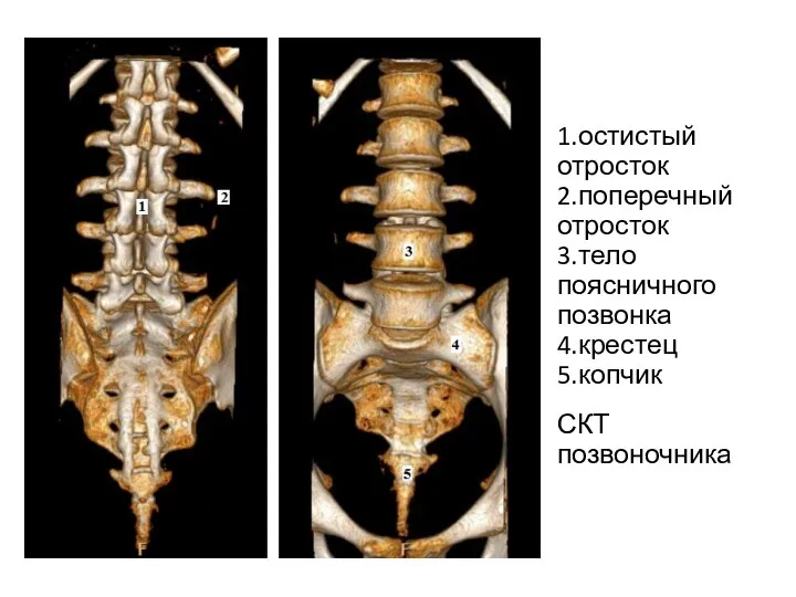 1.остистый отросток 2.поперечный отросток 3.тело поясничного позвонка 4.крестец 5.копчик СКТ позвоночника