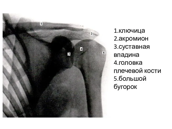 1.ключица 2.акромион 3.суставная впадина 4.головка плечевой кости 5.большой бугорок