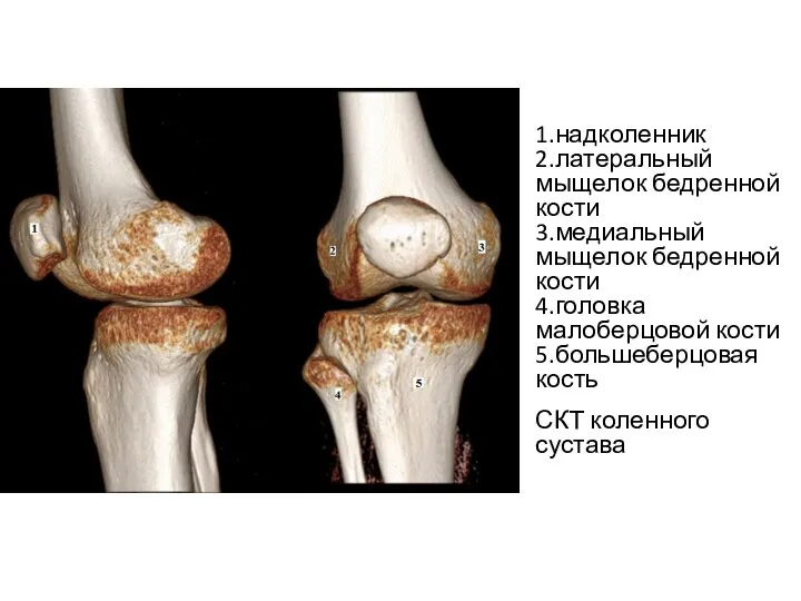 1.надколенник 2.латеральный мыщелок бедренной кости 3.медиальный мыщелок бедренной кости 4.головка малоберцовой кости