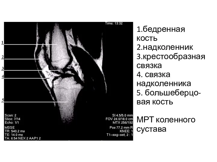 1 2 1.бедренная кость 2.надколенник 3.крестообразная связка 4. связка надколенника 5. большеберцо-вая кость МРТ коленного сустава