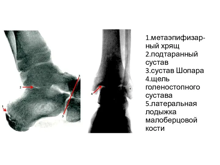 1.метаэпифизар-ный хрящ 2.подтаранный сустав 3.сустав Шопара 4.щель голеностопного сустава 5.латеральная лодыжка малоберцовой кости