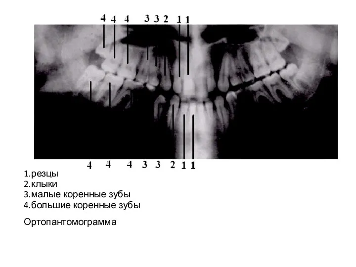 1.резцы 2.клыки 3.малые коренные зубы 4.большие коренные зубы Ортопантомограмма