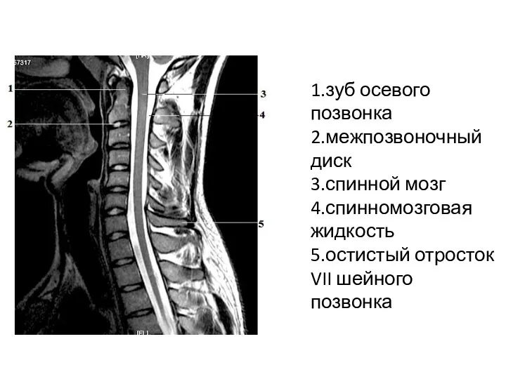 1.зуб осевого позвонка 2.межпозвоночный диск 3.спинной мозг 4.спинномозговая жидкость 5.остистый отросток VII шейного позвонка