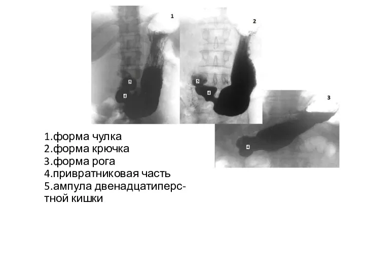 4 5 1.форма чулка 2.форма крючка 3.форма рога 4.привратниковая часть 5.ампула двенадцатиперс- тной кишки