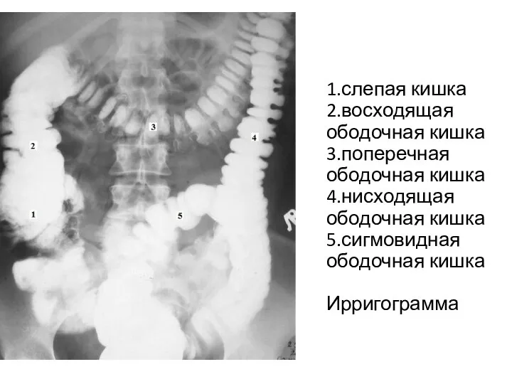 1.слепая кишка 2.восходящая ободочная кишка 3.поперечная ободочная кишка 4.нисходящая ободочная кишка 5.сигмовидная ободочная кишка Ирригограмма