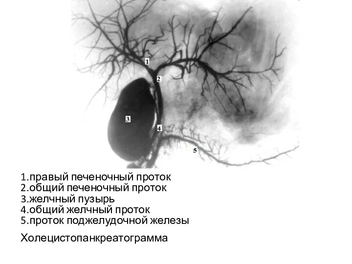 1.правый печеночный проток 2.общий печеночный проток 3.желчный пузырь 4.общий желчный проток 5.проток поджелудочной железы Холецистопанкреатограмма