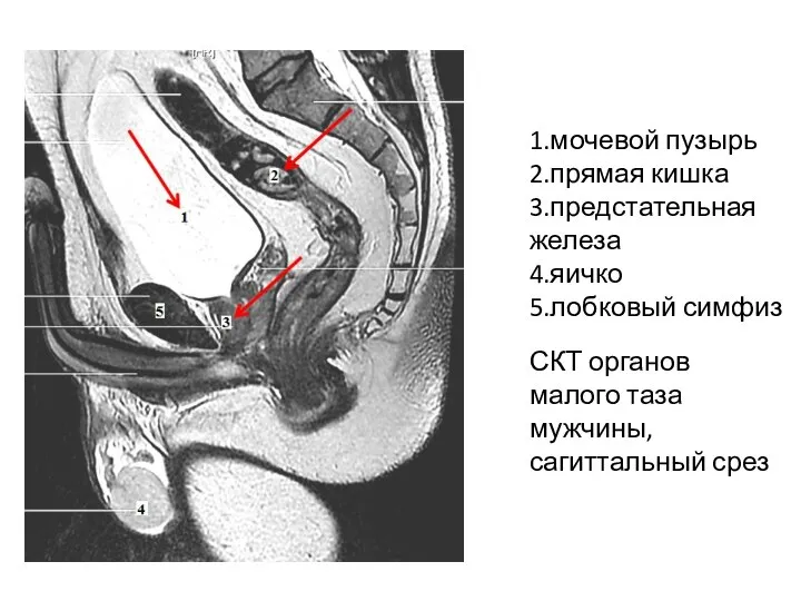 1.мочевой пузырь 2.прямая кишка 3.предстательная железа 4.яичко 5.лобковый симфиз СКТ органов малого таза мужчины, сагиттальный срез