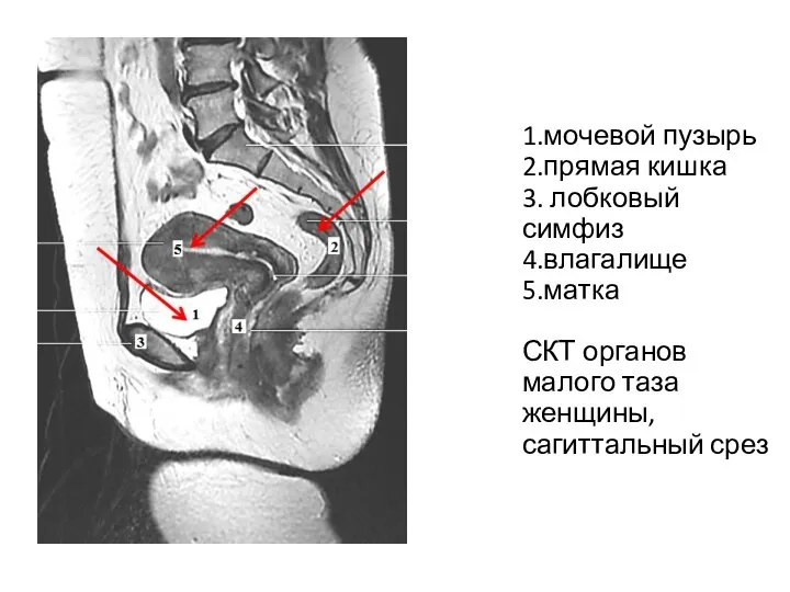 1.мочевой пузырь 2.прямая кишка 3. лобковый симфиз 4.влагалище 5.матка СКТ органов малого таза женщины, сагиттальный срез