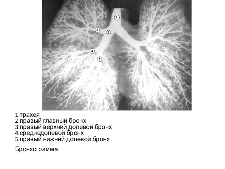 1.трахея 2.правый главный бронх 3.правый верхний долевой бронх 4.среднедолевой бронх 5.правый нижний долевой бронх Бронхограмма